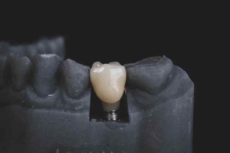 What Makes Dental Implants Different From Dentures and Bridges?